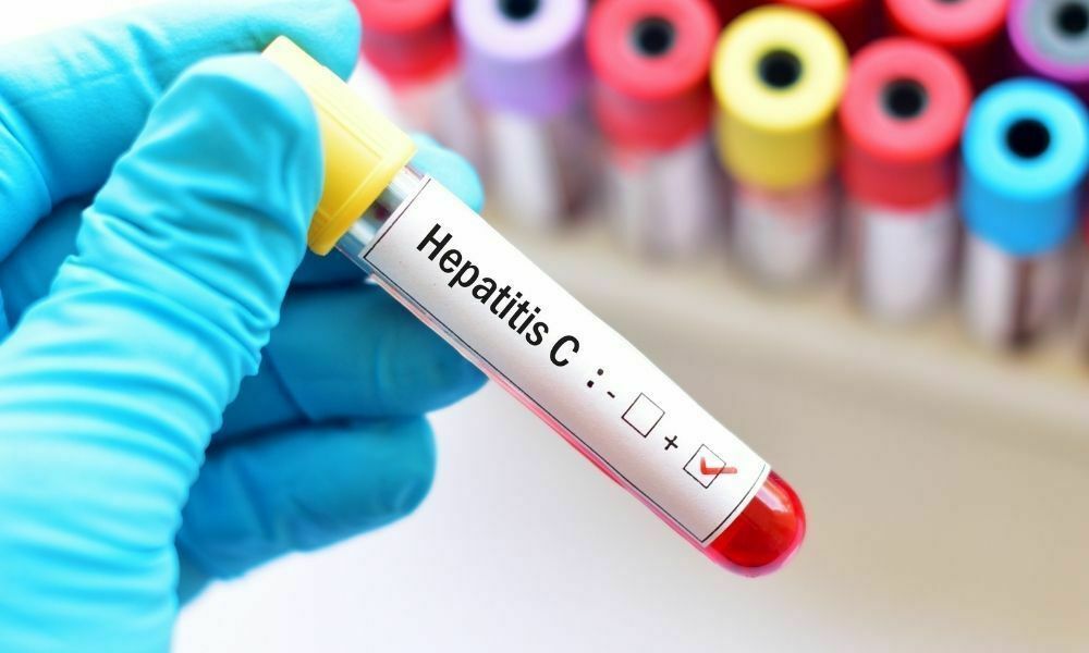 kronik hepatit c tedavisi